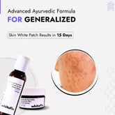 Generalized Vitiligo Treatment | Best Natural Ayurvedic Solutions for Generalized Vitiligo
