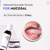 Mucosal Vitiligo Treatment | Best Natural Ayurvedic Solutions for Mucosal Vitiligo