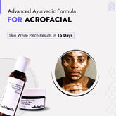 Acrofacial Vitiligo Treatment | Best Natural Ayurvedic Solutions for Acrofacial Vitiligo