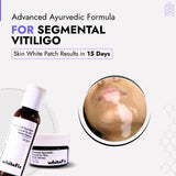 Segmental Vitiligo Treatment | Best Natural Ayurvedic Solutions for Segmental Vitiligo