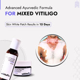 Mixed Vitiligo Treatment | Best Natural Ayurvedic Solutions for Mixed Vitiligo