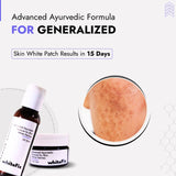 Generalized Vitiligo Treatment | Best Natural Ayurvedic Solutions for Generalized Vitiligo
