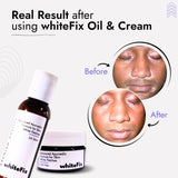 Mixed Vitiligo Treatment | Best Natural Ayurvedic Solutions for Mixed Vitiligo