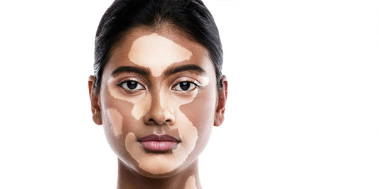 Reclaim Radiant Skin Naturally – How WhiteFix Helps You Fight Vitiligo with Ayurveda