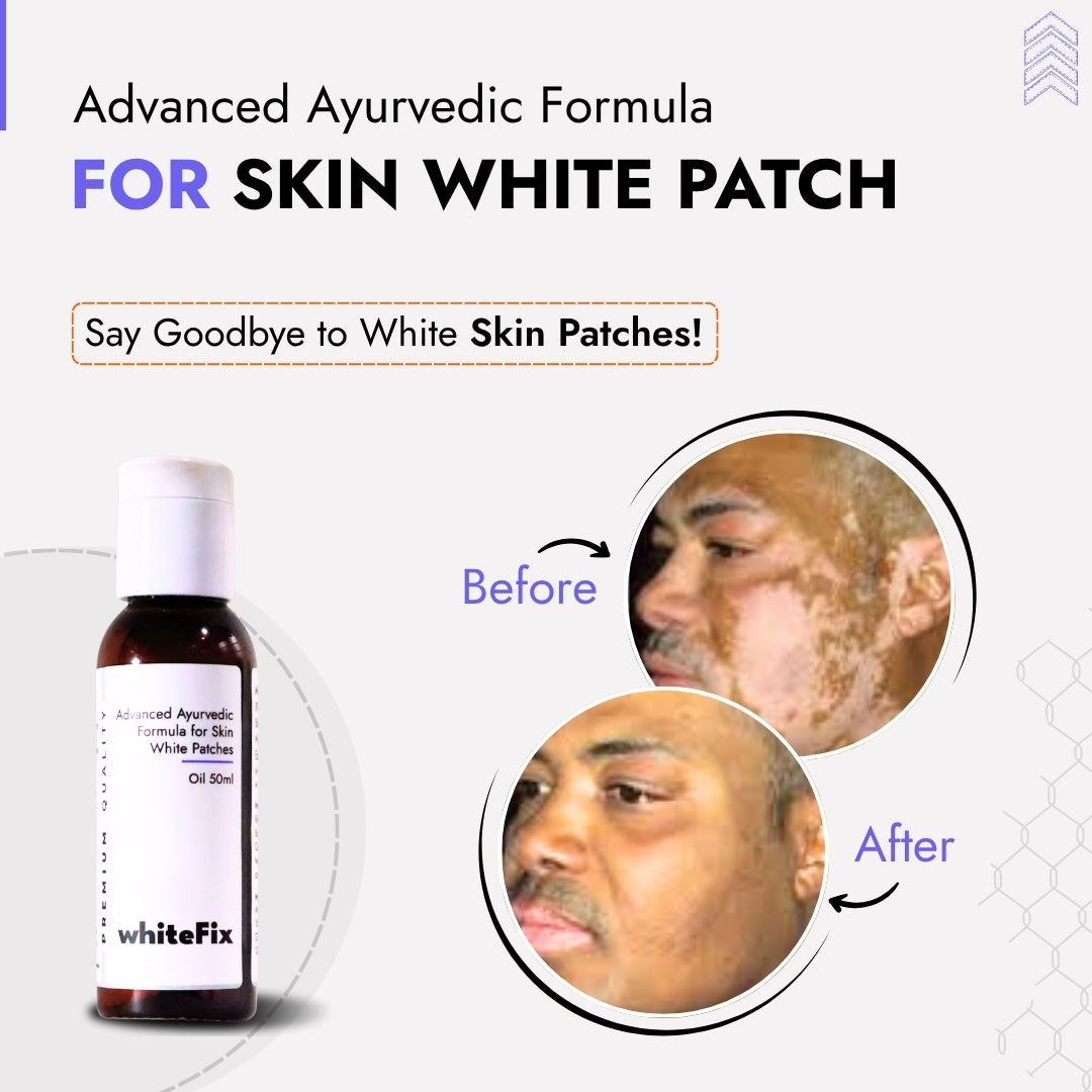 Ayurvedic Natural Oil for Skin White Patches (Vitiligo) - for Day Use