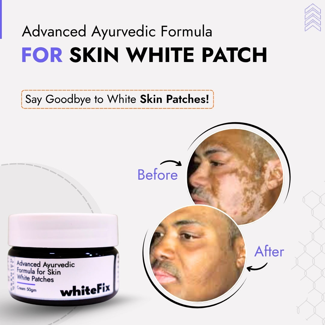 Ayurvedic Herbal Cream for Skin White Patches (Vitiligo) - for Night Use