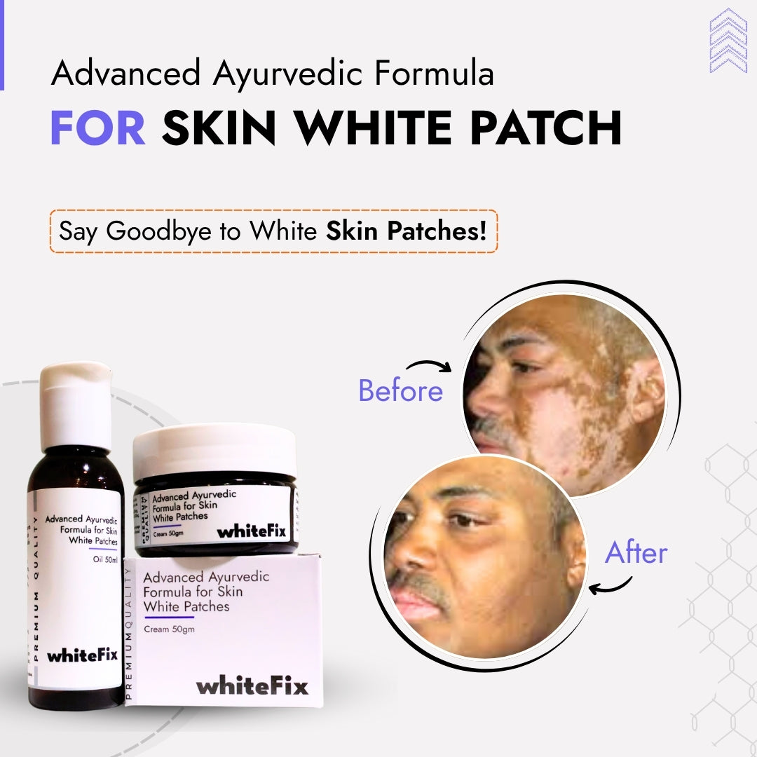 Advanced Ayurvedic Solution Kit for White Skin Patches (vitiligo)- Oil + Herbal Cream