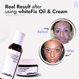 Focal Vitiligo Treatment | Best Natural Ayurvedic Solutions for Focal Vitiligo