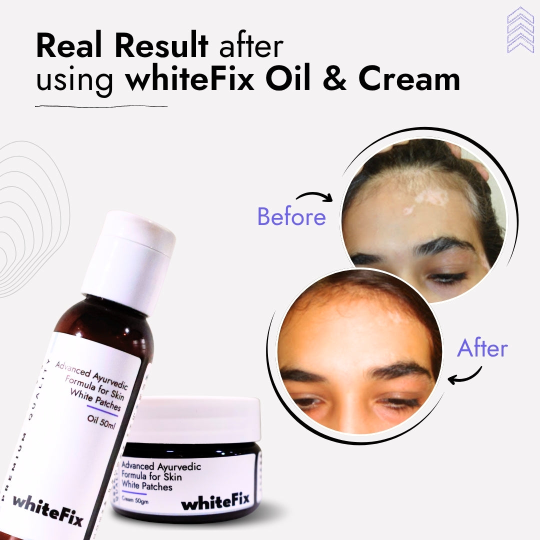 Advanced Ayurvedic Solution Kit for White Skin Patches (vitiligo)- Oil + Herbal Cream