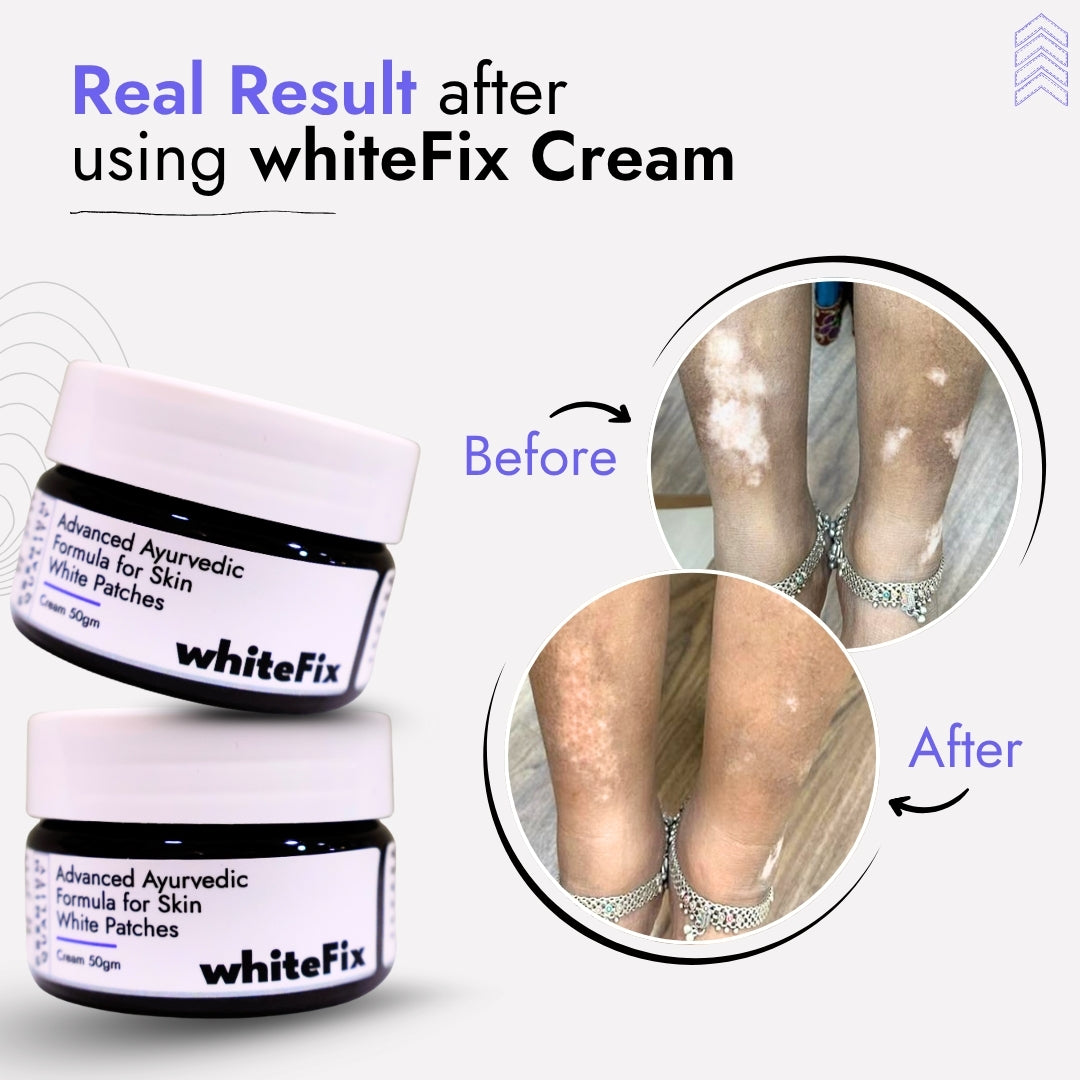 Ayurvedic Herbal Cream for Skin White Patches (Vitiligo) - for Night Use