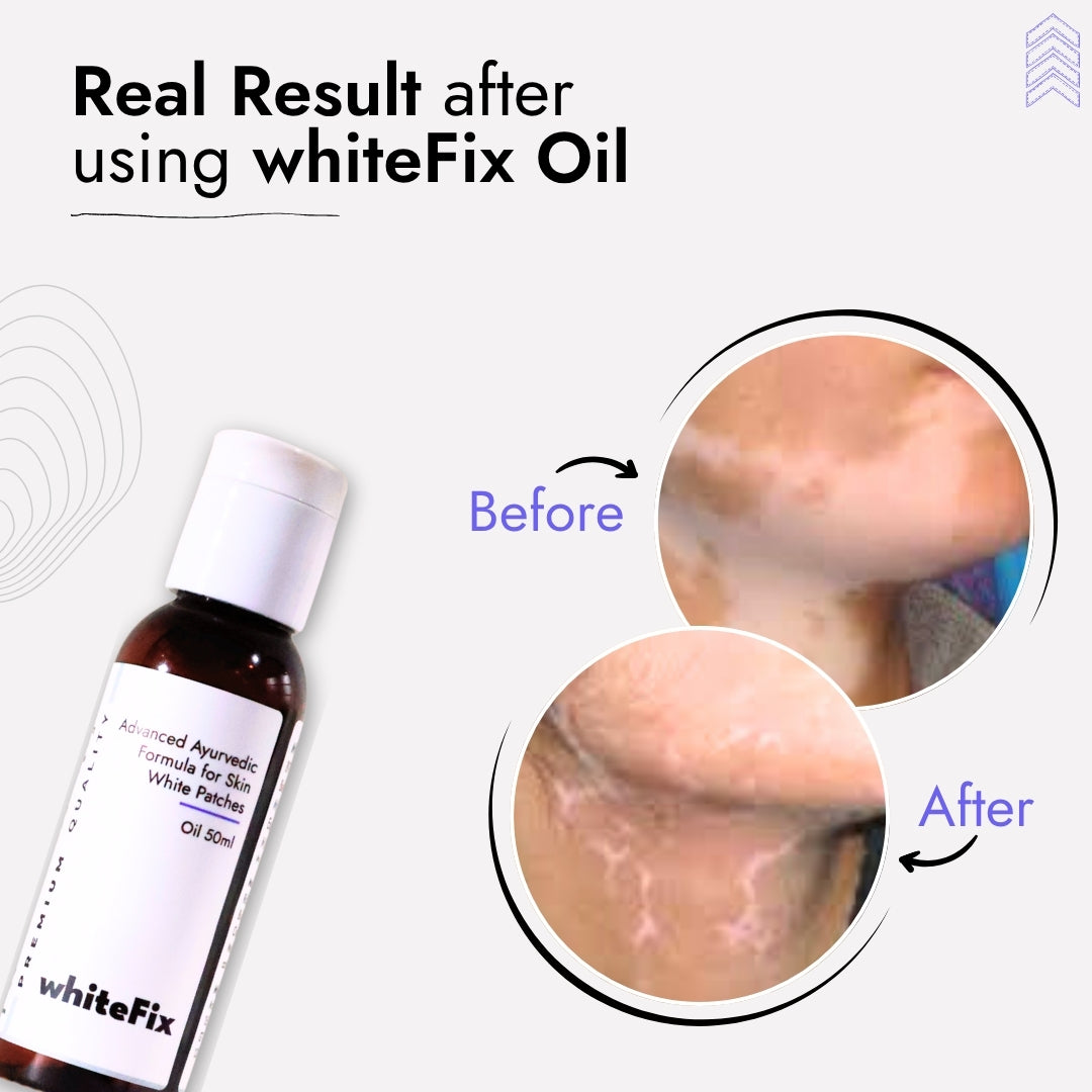 Ayurvedic Natural Oil for Skin White Patches (Vitiligo) - for Day Use