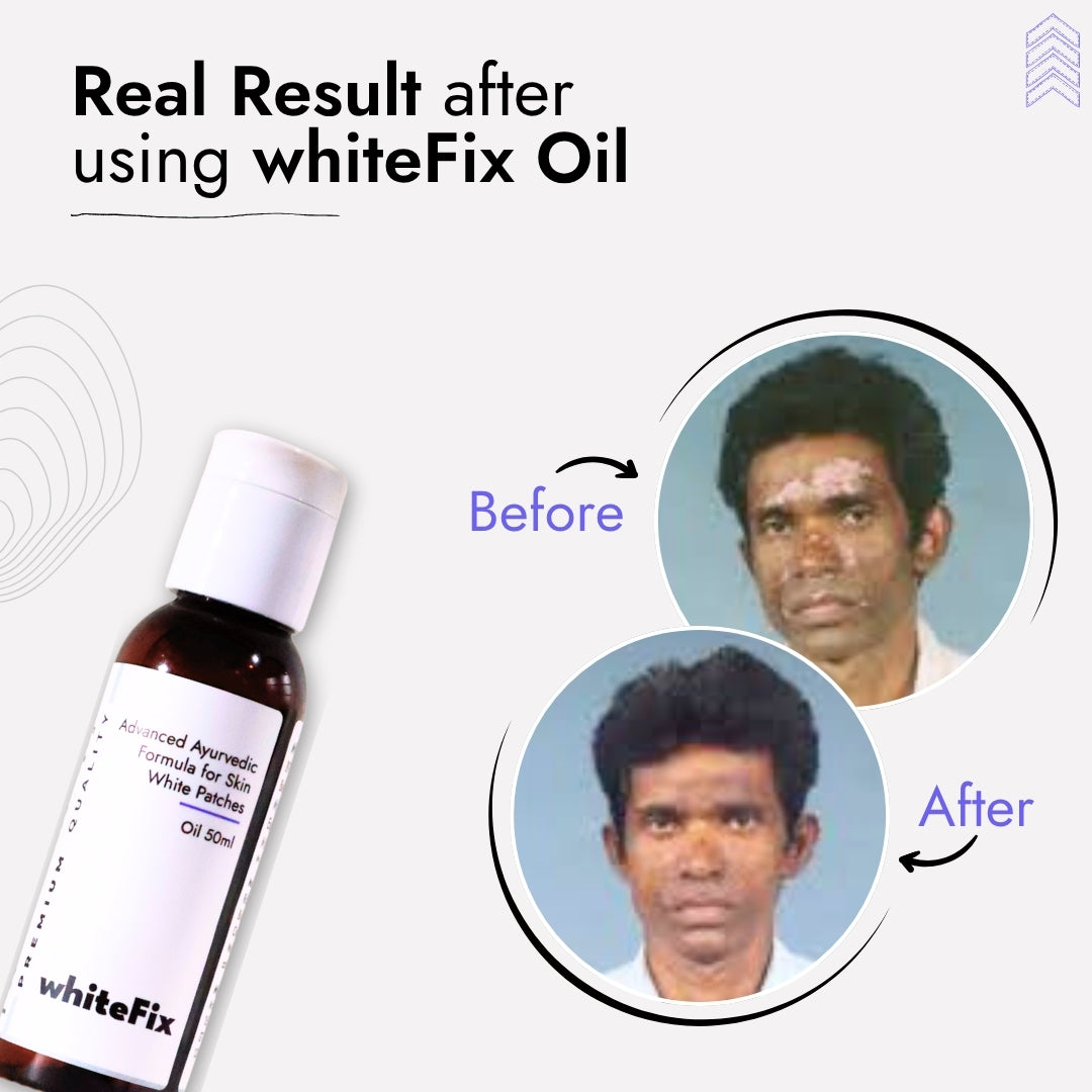 Ayurvedic Natural Oil for Skin White Patches (Vitiligo) - for Day Use