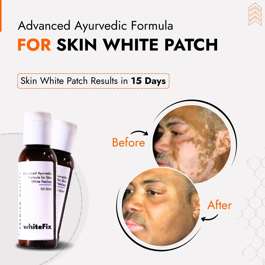 Ayurvedic Natural Oil for Skin White Patches (Vitiligo) - for Day Use