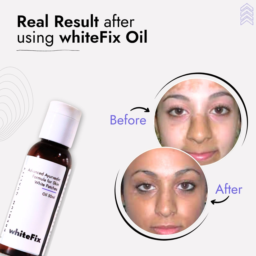 Ayurvedic Natural Oil for Skin White Patches (Vitiligo) - for Day Use