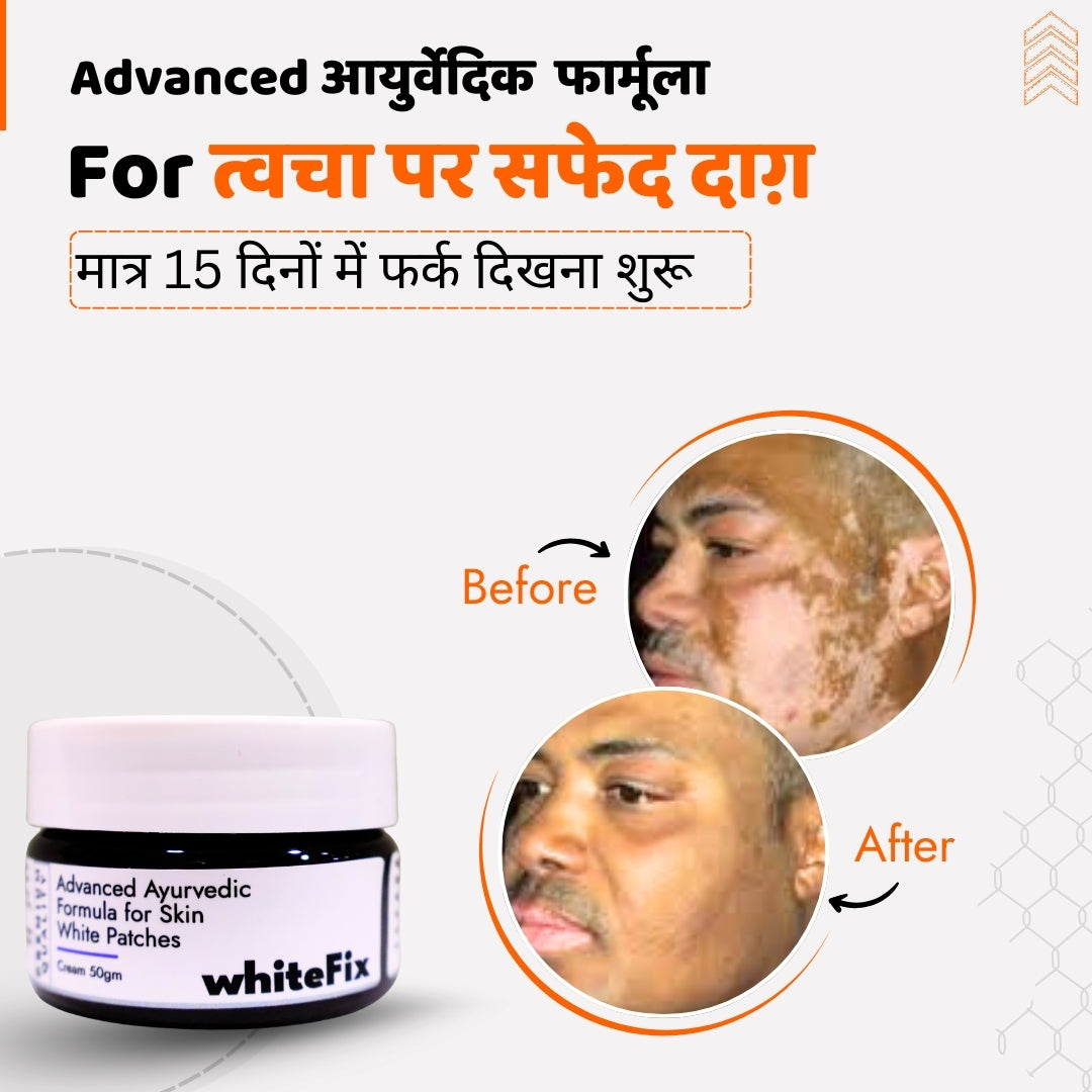 सफेद दाग (विटिलिगो) के लिए आयुर्वेदिक हर्बल क्रीम — रात में उपयोग के लिए