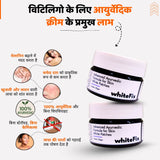 सफेद दाग (विटिलिगो) के लिए आयुर्वेदिक हर्बल क्रीम — रात में उपयोग के लिए