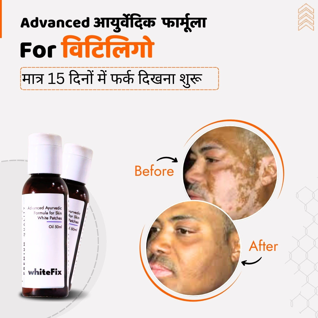 एडवांस्ड आयुर्वेदिक सॉल्यूशन किट फॉर व्हाइट स्किन पैचेस (विटिलिगो) - ऑयल + हर्बल क्रीम